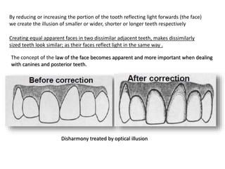 By reducing or increasing the portion of the tooth reflecting light forwards (the face)
we create the illusion of smaller or wider, shorter or longer teeth respectively
Creating equal apparent faces in two dissimilar adjacent teeth, makes dissimilarly
sized teeth look similar; as their faces reflect light in the same way .
Disharmony treated by optical illusion
The concept of the law of the face becomes apparent and more important when dealing
with canines and posterior teeth.
 