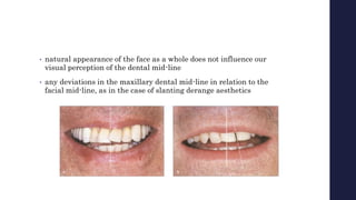 • natural appearance of the face as a whole does not influence our
visual perception of the dental mid-line
• any deviations in the maxillary dental mid-line in relation to the
facial mid-line, as in the case of slanting derange aesthetics
 