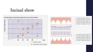 Incisal show
 