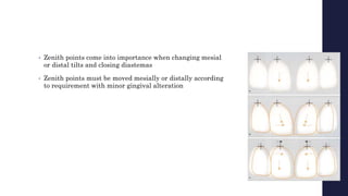 • Zenith points come into importance when changing mesial
or distal tilts and closing diastemas
• Zenith points must be moved mesially or distally according
to requirement with minor gingival alteration
 