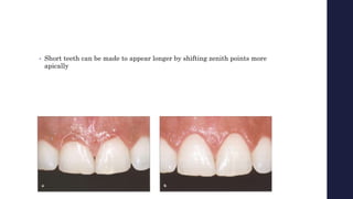 • Short teeth can be made to appear longer by shifting zenith points more
apically
 