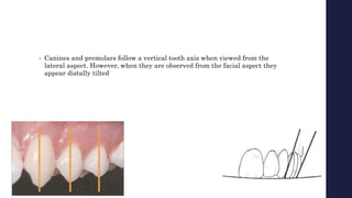 • Canines and premolars follow a vertical tooth axis when viewed from the
lateral aspect. However, when they are observed from the facial aspect they
appear distally tilted
 