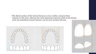 • The distal surface of the lateral Incisors is less visible, owing to their
rotation in the arch, whereas the most dominant anterior teeth in the dental
arch, the maxillary central incisors, can be seen in their full size.
 