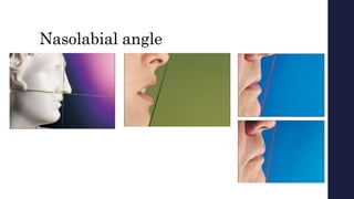 Nasolabial angle
 