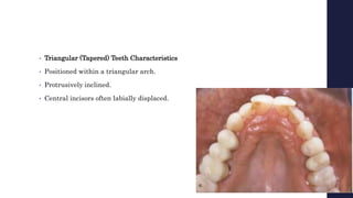 • Triangular (Tapered) Teeth Characteristics
• Positioned within a triangular arch.
• Protrusively inclined.
• Central incisors often labially displaced.
 