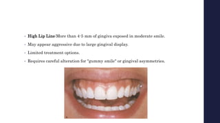 • High Lip Line:More than 4-5 mm of gingiva exposed in moderate smile.
• May appear aggressive due to large gingival display.
• Limited treatment options.
• Requires careful alteration for "gummy smile" or gingival asymmetries.
 