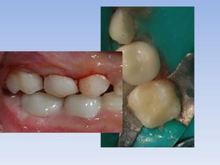 Esthetic crowns for posterior primary teeth