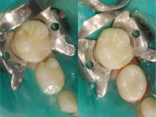 Esthetic crowns for posterior primary teeth