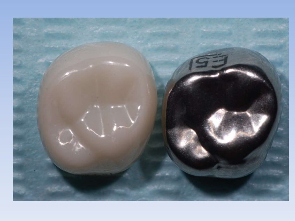 Esthetic crowns for posterior primary teeth