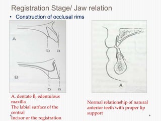 Registration Stage/ Jaw relation
• Construction of occlusal rims
A, dentate B, edentulous
maxilla
The labial surface of the
central
Incisor or the registration
Normal relationship of natural
anterior teeth with proper lip
support
 