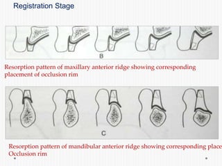 Registration Stage
Resorption pattern of maxillary anterior ridge showing corresponding
placement of occlusion rim
Resorption pattern of mandibular anterior ridge showing corresponding placem
Occlusion rim
 