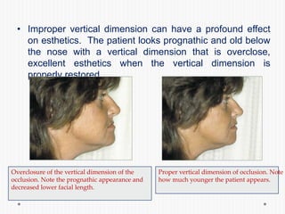 • Improper vertical dimension can have a profound effect
on esthetics. The patient looks prognathic and old below
the nose with a vertical dimension that is overclose,
excellent esthetics when the vertical dimension is
properly restored.
Overclosure of the vertical dimension of the
occlusion. Note the prognathic appearance and
decreased lower facial length.
Proper vertical dimension of occlusion. Note
how much younger the patient appears.
 