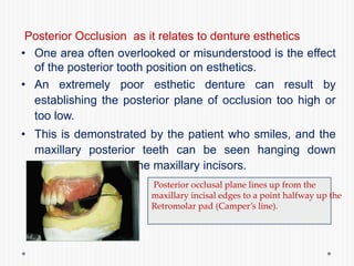 Posterior Occlusion as it relates to denture esthetics
• One area often overlooked or misunderstood is the effect
of the posterior tooth position on esthetics.
• An extremely poor esthetic denture can result by
establishing the posterior plane of occlusion too high or
too low.
• This is demonstrated by the patient who smiles, and the
maxillary posterior teeth can be seen hanging down
below the plane of the maxillary incisors.
Posterior occlusal plane lines up from the
maxillary incisal edges to a point halfway up the
Retromolar pad (Camper’s line).
 