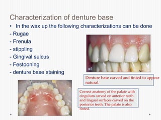 Characterization of denture base
• In the wax up the following characterizations can be done
- Rugae
- Frenula
- stippling
- Gingival sulcus
- Festooning
- denture base staining
Denture base carved and tinted to appear
natural.
Correct anatomy of the palate with
cingulum carved on anterior teeth
and lingual surfaces carved on the
posterior teeth. The palate is also
tinted.
 