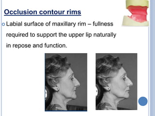 Occlusion contour rims
 Labial surface of maxillary rim – fullness
required to support the upper lip naturally
in repose and function.
 