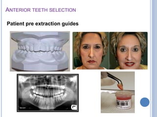 ANTERIOR TEETH SELECTION
Patient pre extraction guides
 