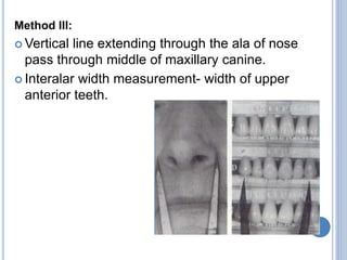 Method III:
 Vertical line extending through the ala of nose
pass through middle of maxillary canine.
 Interalar width measurement- width of upper
anterior teeth.
 