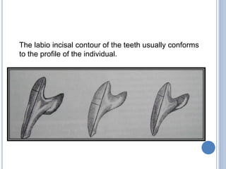 The labio incisal contour of the teeth usually conforms
to the profile of the individual.
 