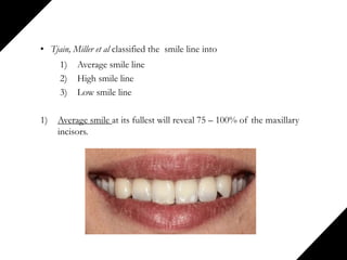 • Tjain, Miller et al classified the smile line into
1) Average smile line
2) High smile line
3) Low smile line
1) Average smile at its fullest will reveal 75 – 100% of the maxillary
incisors.
 
