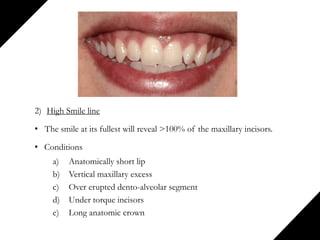 2) High Smile line
• The smile at its fullest will reveal >100% of the maxillary incisors.
• Conditions
a) Anatomically short lip
b) Vertical maxillary excess
c) Over erupted dento-alveolar segment
d) Under torque incisors
e) Long anatomic crown
 