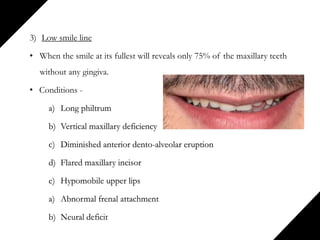 3) Low smile line
• When the smile at its fullest will reveals only 75% of the maxillary teeth
without any gingiva.
• Conditions -
a) Long philtrum
b) Vertical maxillary deficiency
c) Diminished anterior dento-alveolar eruption
d) Flared maxillary incisor
e) Hypomobile upper lips
a) Abnormal frenal attachment
b) Neural deficit
 