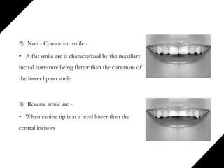 2) Non - Consonant smile -
• A flat smile arc is characterized by the maxillary
incisal curvature being flatter than the curvature of
the lower lip on smile
3) Reverse smile arc -
• When canine tip is at a level lower than the
central incisors
 