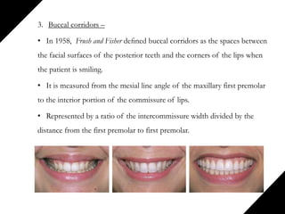3. Buccal corridors –
• In 1958, Frush and Fisher deﬁned buccal corridors as the spaces between
the facial surfaces of the posterior teeth and the corners of the lips when
the patient is smiling.
• It is measured from the mesial line angle of the maxillary first premolar
to the interior portion of the commissure of lips.
• Represented by a ratio of the intercommissure width divided by the
distance from the first premolar to first premolar.
 