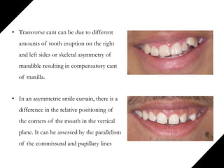 • Transverse cant can be due to different
amounts of tooth eruption on the right
and left sides or skeletal asymmetry of
mandible resulting in compensatory cant
of maxilla.
• In an asymmetric smile curtain, there is a
difference in the relative positioning of
the corners of the mouth in the vertical
plane. It can be assessed by the parallelism
of the commissural and pupillary lines
 