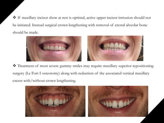  If maxillary incisor show at rest is optimal, active upper incisor intrusion should not
be initiated. Instead surgical crown lengthening with removal of crestal alveolar bone
should be made.
 Treatment of most severe gummy smiles may require maxillary superior repositioning
surgery (Le Fort I osteotomy) along with reduction of the associated vertical maxillary
excess with/without crown lengthening.
 