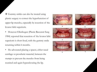  Gummy smiles can also be treated using
plastic surgery to correct the hyperfunction of
upper lip muscles, especially by resection of the
levator labii superioris.
• However Ellenbogen (Plastic Reconstr Surg
1984) reported that resection of the levator labii
superioris is short-lived, with the gummy smile
returning within 6 months.
• He advocated placing a spacer, either nasal
cartilage or prosthetic material, between the
stumps to prevent the muscles from being
reunited and again hyperelevating the lip.
 
