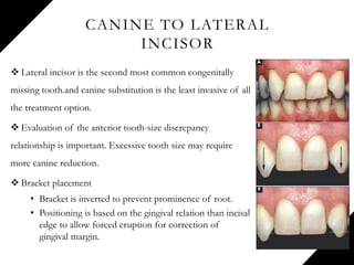 CANINE TO LATERAL
INCISOR
 Lateral incisor is the second most common congenitally
missing tooth.and canine substitution is the least invasive of all
the treatment option.
 Evaluation of the anterior tooth-size discrepancy
relationship is important. Excessive tooth size may require
more canine reduction.
 Bracket placement
• Bracket is inverted to prevent prominence of root.
• Positioning is based on the gingival relation than incisal
edge to allow forced eruption for correction of
gingival margin.
 