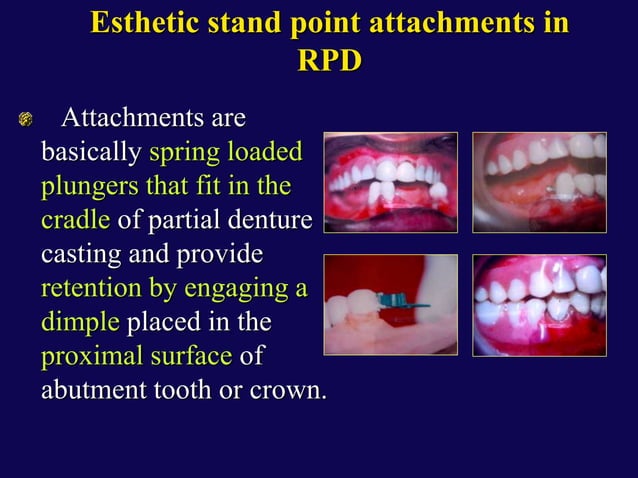 Wht Is Twin Flex Rpd esthetics in RPD.ppt