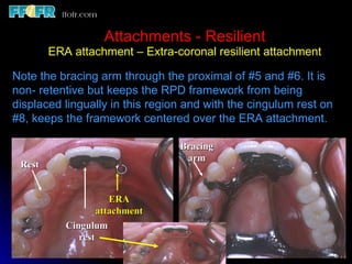 Long Box Rests For Rotational Path Rpd Esthetics, rotational path, attachments | PPT