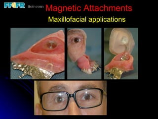 Magnetic Attachments Maxillofacial applications 