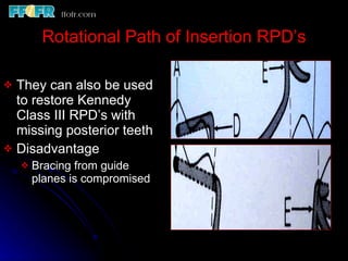 Guide Plane Rpd Continous Esthetics, rotational path, attachments | PPT
