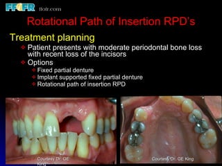 Rotational Rpd Esthetics, rotational path, attachments | PPT