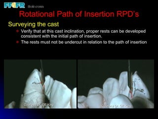 Rotational Rpd Esthetics, rotational path, attachments | PPT