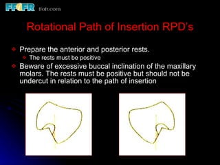Rotational Rpd Esthetics, rotational path, attachments | PPT