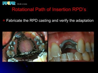 Rotational Rpd Esthetics, rotational path, attachments | PPT