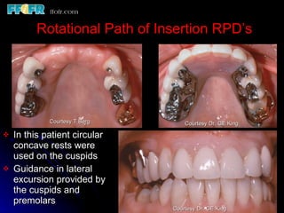 Rotational Rpd Esthetics, rotational path, attachments | PPT