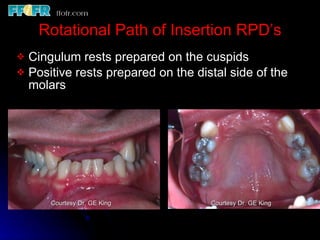 Rotational Rpd Esthetics, rotational path, attachments | PPT