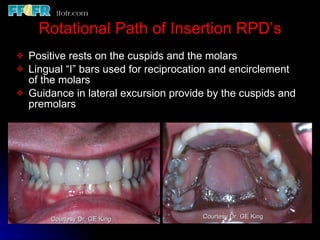 Rotational Rpd Esthetics, rotational path, attachments | PPT