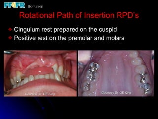 Rotational Path of Insertion RPD’s Cingulum rest prepared on the cuspid Positive rest on the premolar and molars Courtesy Dr. GE King Courtesy Dr. GE King 