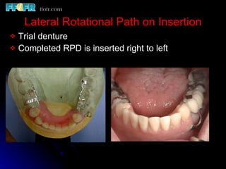 Rotational Rpd Esthetics, rotational path, attachments | PPT
