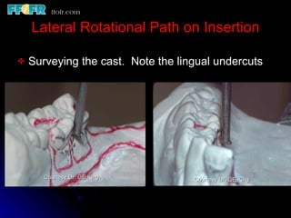 Esthetics, rotational path, attachments | PPT