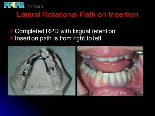 Rotational Rpd Esthetics, rotational path, attachments | PPT