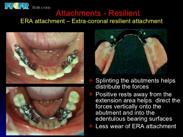 Esthetics, rotational path, attachments