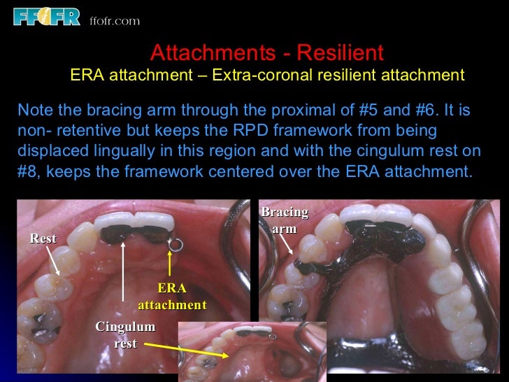 Esthetics, rotational path, attachments