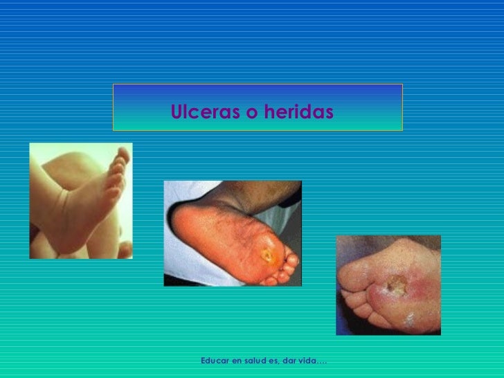 Estilo de vida y pie diabetico. Estilo de vida y pie diabetico.