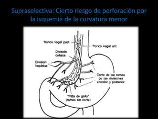 Supraselectiva: Cierto riesgo de perforación por
la isquemia de la curvatura menor
 